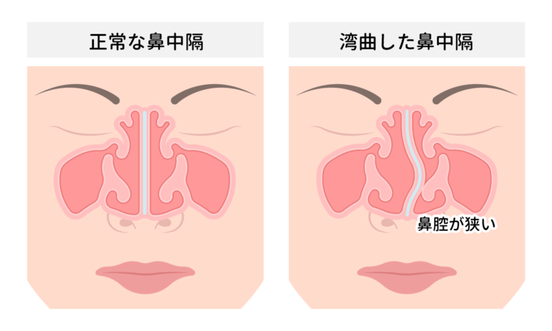 鼻中隔矯正術 | 鼻中隔弯曲症の日帰り手術 | 王子くろこ耳鼻咽喉科 