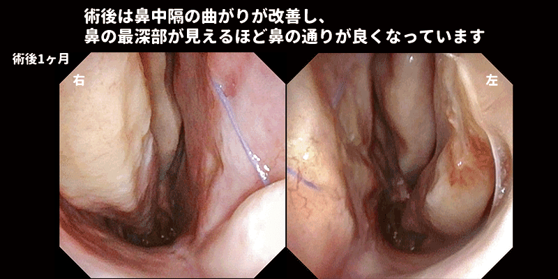 鼻中隔矯正術 | 鼻中隔弯曲症の日帰り手術 | 王子くろこ耳鼻咽喉科 