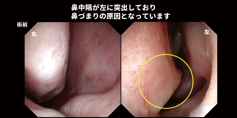 鼻中隔矯正術 | 鼻中隔弯曲症の日帰り手術 | 王子くろこ耳鼻咽喉科 