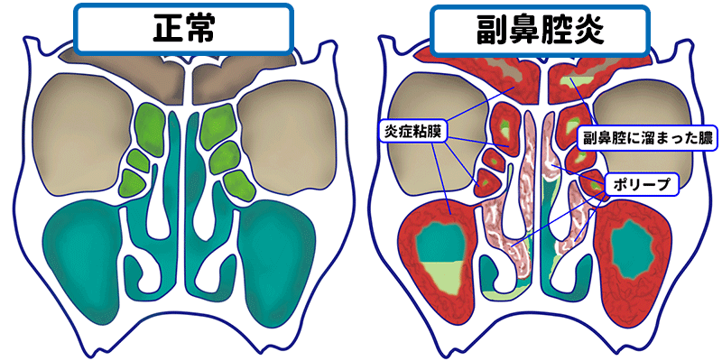 鼻ポリープの原因と危険因子