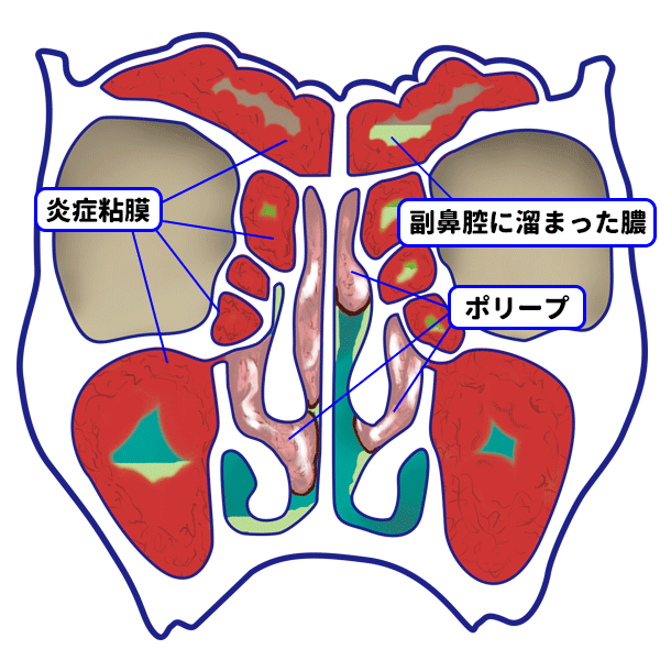 内視鏡下鼻副鼻腔手術 ~副鼻腔炎(蓄膿症)の日帰り手術~ | 王子くろこ耳鼻咽喉科